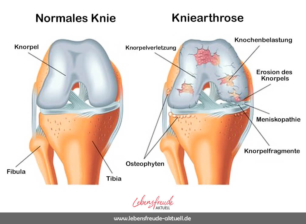 Beule am knie